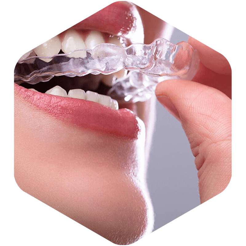 Female wearing clear aligners